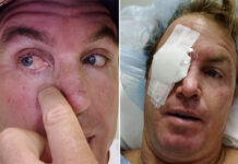 Jamie O’Brien Can’t Surf for Months After Pterygium Surgery