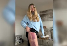 Australian Shark Attack Survivor Suffers Setback in Recovery