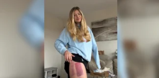 Australian Shark Attack Survivor Suffers Setback in Recovery