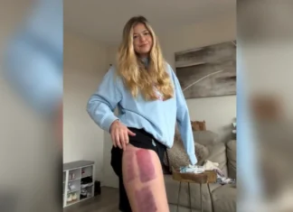 Australian Shark Attack Survivor Suffers Setback in Recovery